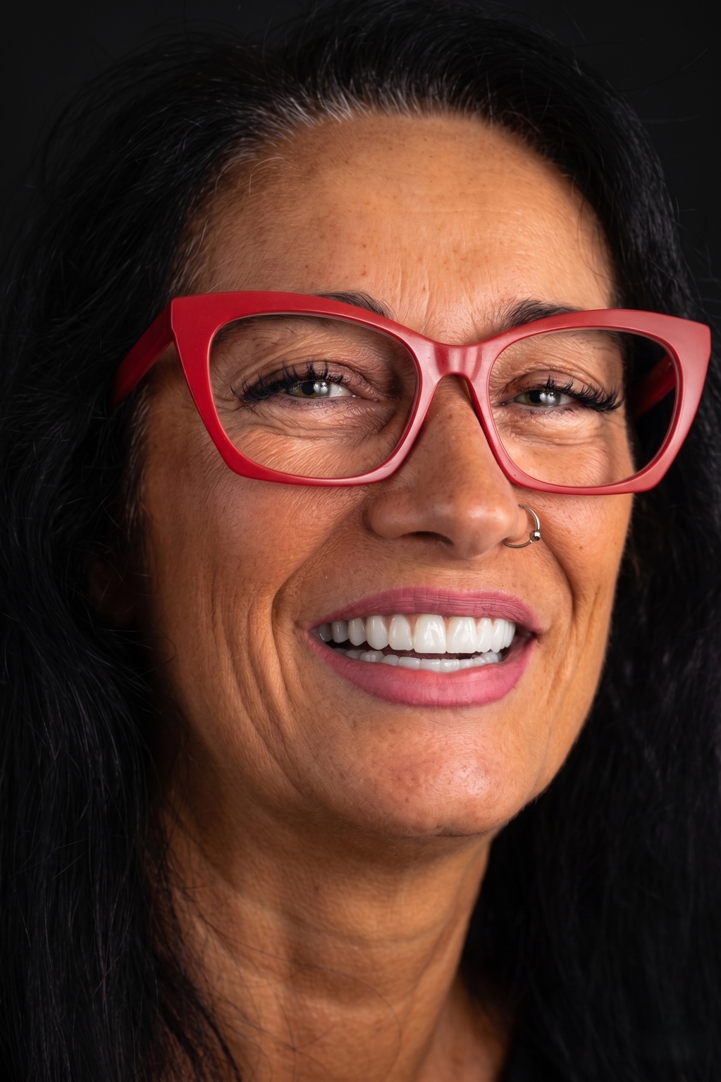 Real patient after All-on-6 full-arch dental rehabilitation