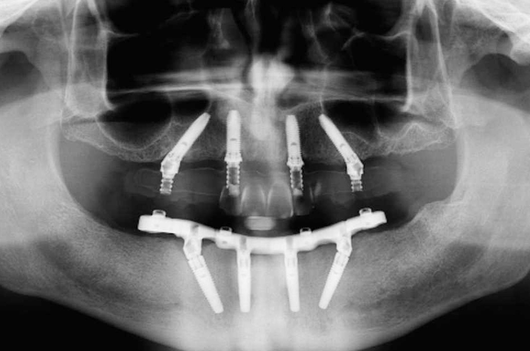 Ortopanoramica con riabilitazione su quattro impianti