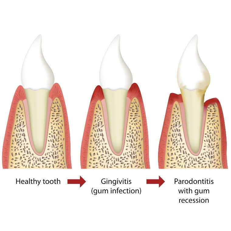 Progressione illustrata da dente sano a gengivite e parodontite con recessione gengivale