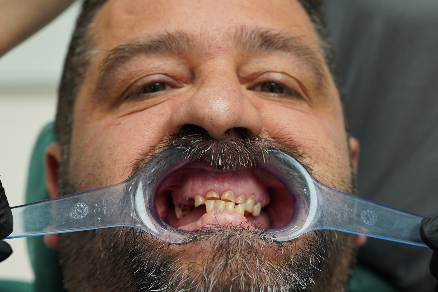 Situazione dentale di Mario prima del trattamento