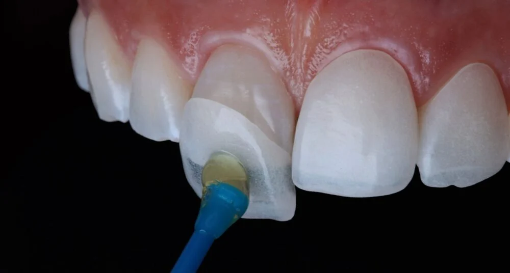 Faccette dentali E-Max