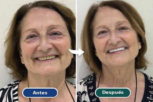 Caso real de estética dental: antes y después