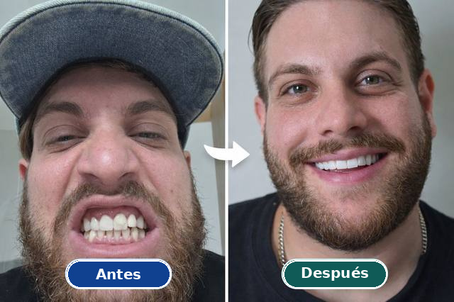 Caso real de armonizzazione del sonrisa: antes y después