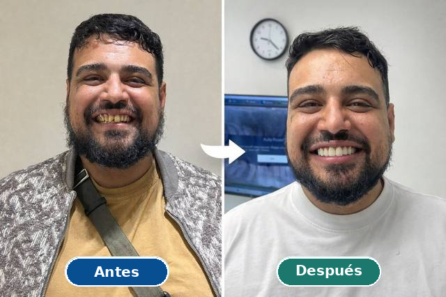 Caso real de rehabilitación estetica: antes y después