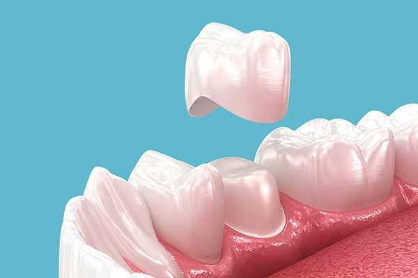Corone dentali in zirconio