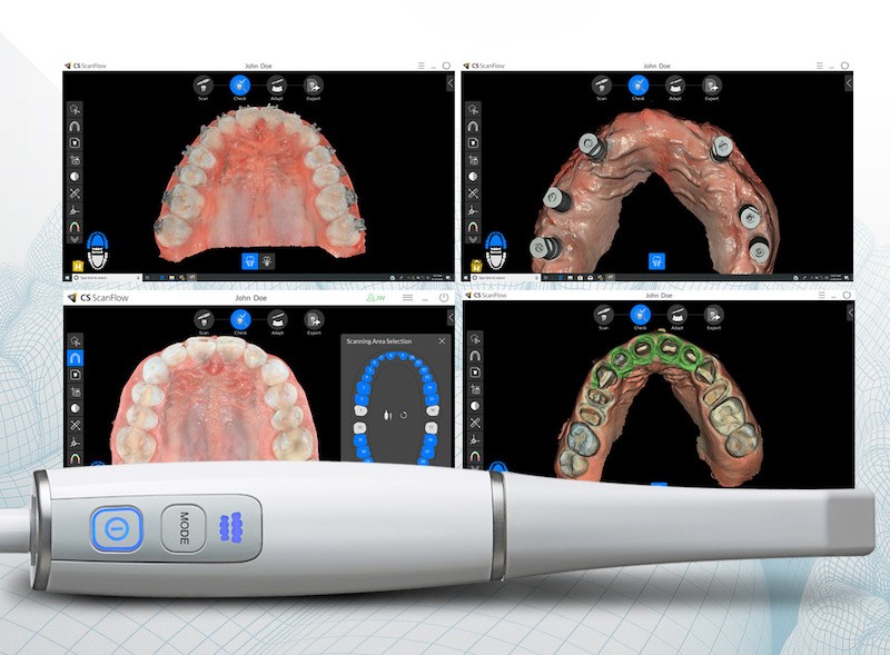 Intraoral scanner and digital dental diagnostic technology