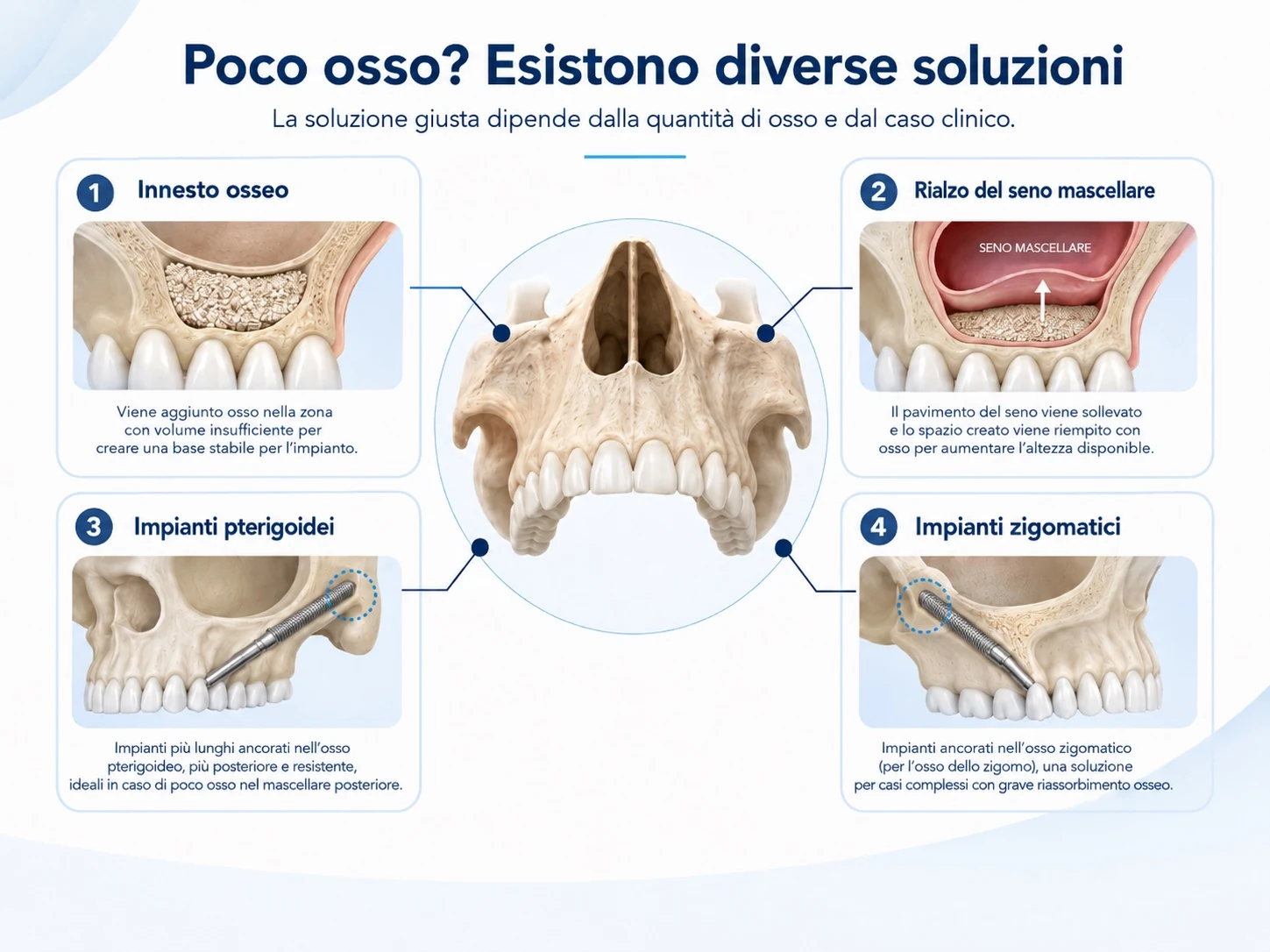 Schema delle principali soluzioni in caso di poco osso per impianti dentali: innesto osseo, rialzo del seno mascellare, impianti pterigoidei e zigomatici