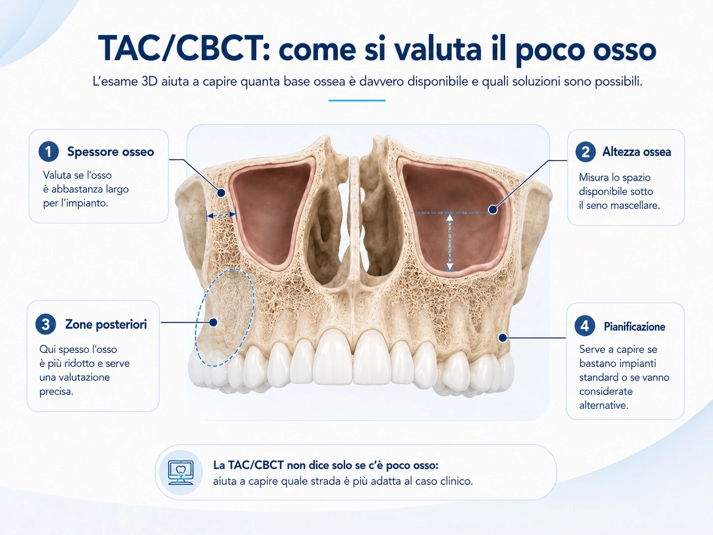 Schema TAC CBCT per valutare spessore e altezza dell’osso disponibile prima di un trattamento implantare