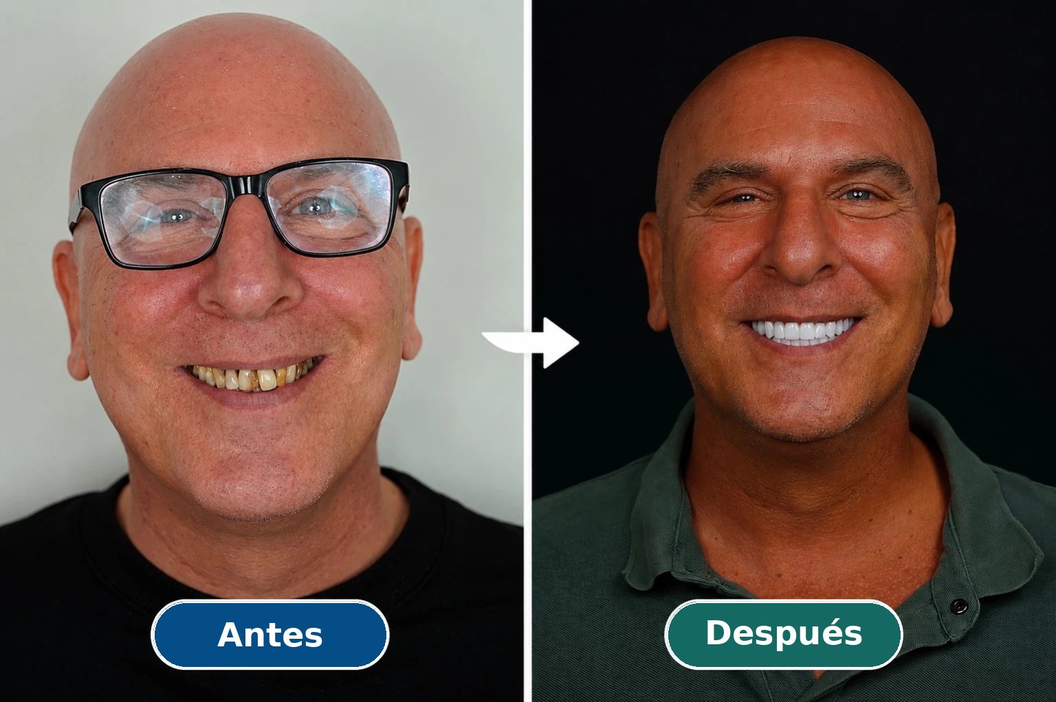 Caso real de rehabilitación implantológica: antes y después