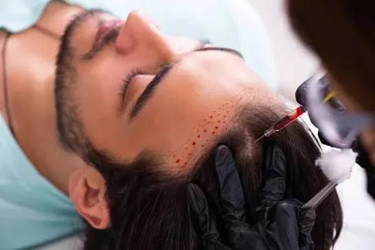 Procedura di trapianto di capelli